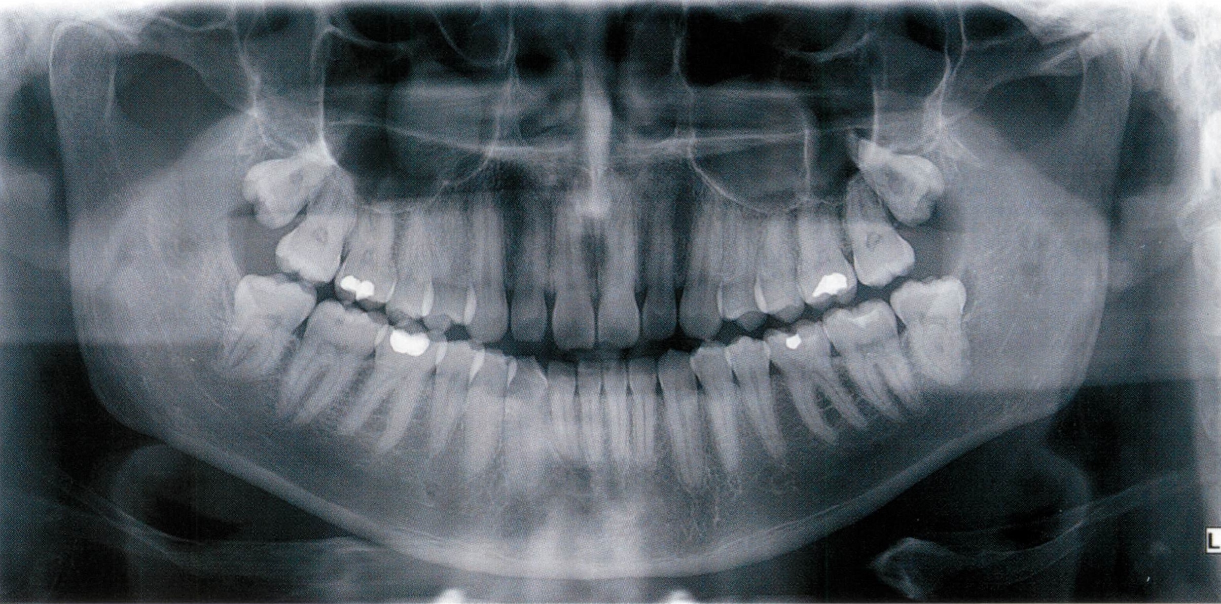 Снимок. Рентген ортопантомограмма зубов. Перикоронит ортопантомограмма.