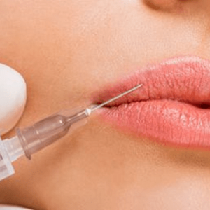 Esecuzione di un trattamento filler labbra e antirughe