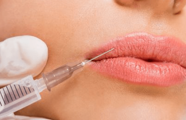 Esecuzione di un trattamento filler labbra e antirughe