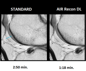Software di Intelligenza Artificiale AIR Recon DL - Risonanza magnetica roma ad alto campo - 2