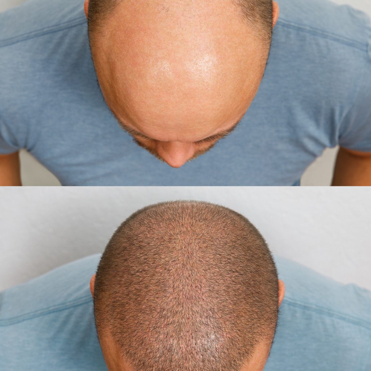 The head of a balding man before and after hair transplant surgery. A man losing his hair has become shaggy. An advertising poster for a hair transplant clinic. Treatment of baldness